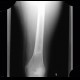 Bone infarction, atherosclerosis: X-ray - Plain radiograph